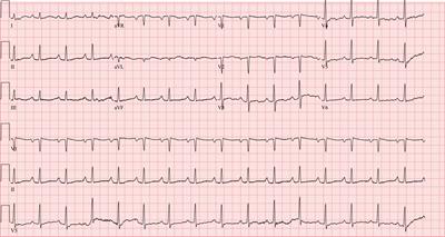 Case report: eosinophilic myocarditis in hypereosinophilic syndrome: a journey to heart transplantation